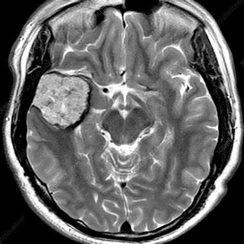 Cavernous Malformation Mri Stock Image C0365110 Science Photo