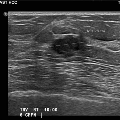 Diagnostic Mammogram With Mlo View A And Magnification View B From