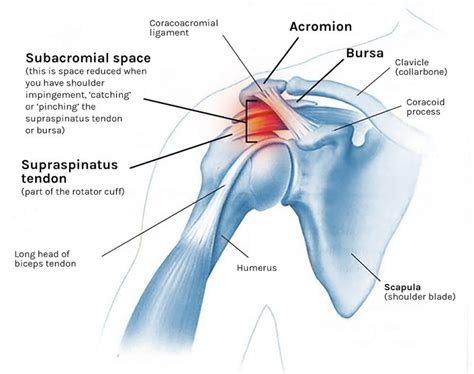 Shoulder impingement cause and treatment with 4 exercises