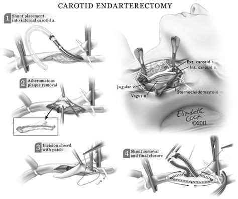 Carotid Artery Blockage. carotid artery blockage surgery, carotid ...