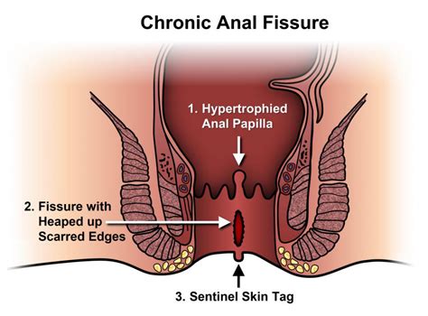 All About The Anal Fissure Treatments City Of El Cenizo