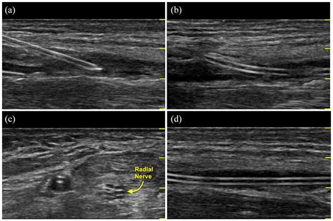 10 Best Practice Tips With Radial Arterial Catheterization Guglielmo