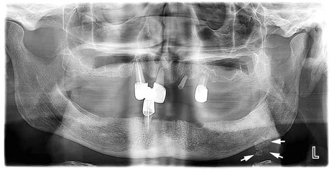 Sialoliths Of Submandibular Gland And Whartons Duct Orthopantomography