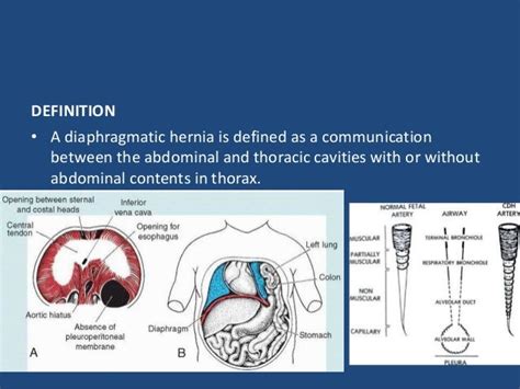 Diaphragmatic hernia