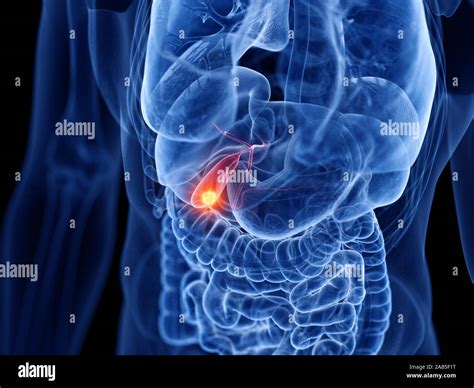 3d Rendered Medically Accurate Illustration Of The Gallbladder Cancer