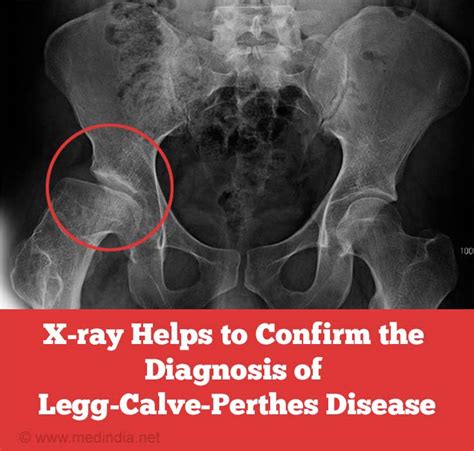 Legg-Calvé-Perthes Disease - Childhood Bone Disorder