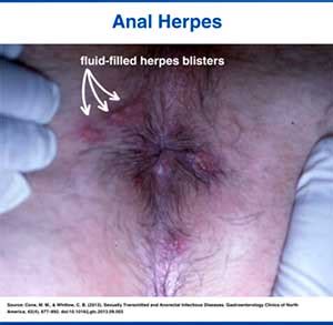 STDs As A Cause Of Anal Itching