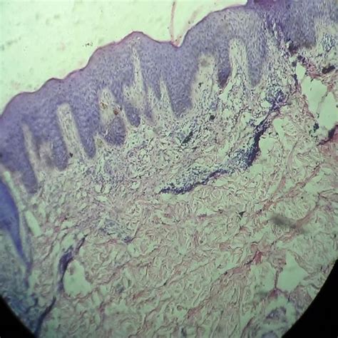 Skin Biopsy A Hyperkeratosis And Irregular Acanthosis Suggestive Of