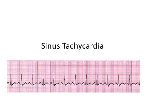 Sinus tachycardia | PPT