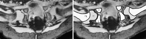 Axial Magnetic Resonance Imaging Mri Of Human Neonatal Hips A And Download Scientific