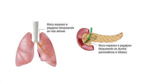 Fibrose Cística O Que é Epidemiologia E Mais Sanar Medicina