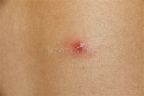 Close Up Of A Pimple On The Back Stock Photo Image Of Concept