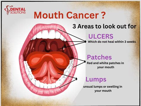 Mouth Cancer Early Detection Can Save Life Best Dental Clinic In Bangalore Indiranagar Best