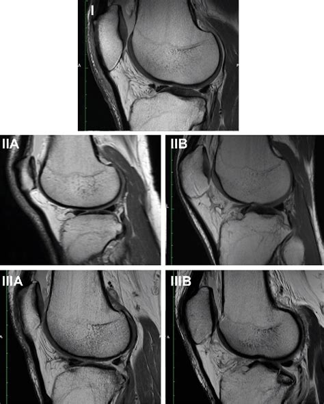 Figure 2 From Morphologic Variants Of Posterolateral Tibial Plateau