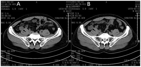 Retrospective Analysis Of 9 Cases Of Appendiceal Mucocele In 3 071