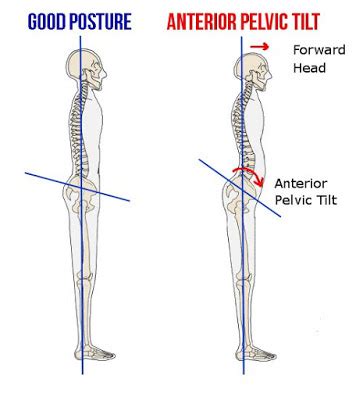 Posterior Pelvic Tilt vs Anterior Pelvic Tilt — BE