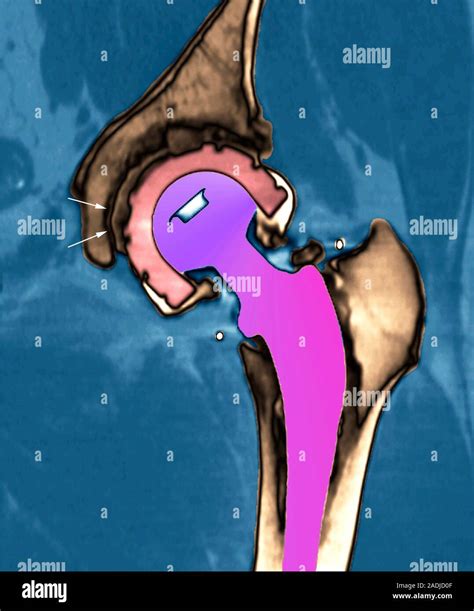 Loosened Hip Replacement Coloured Computed Tomography CT Scan Of The