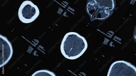 Magnetic Resonance Imaging Of An Older Man S Brain After A Traumatic