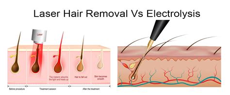 Laser Hair Removal Vs Electrolysis Which Is Better Laserskinca