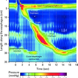 Esophageal High Resolution Manometry Patterns From Left To Right