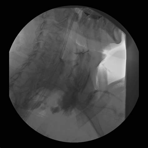 Esophageal Perforation RADIOLOGYPICS