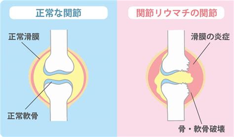 関節リウマチ 吉田病院