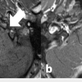 Sagittal T2 Weighted Spin Echo MRI Image Of The Midline Brain