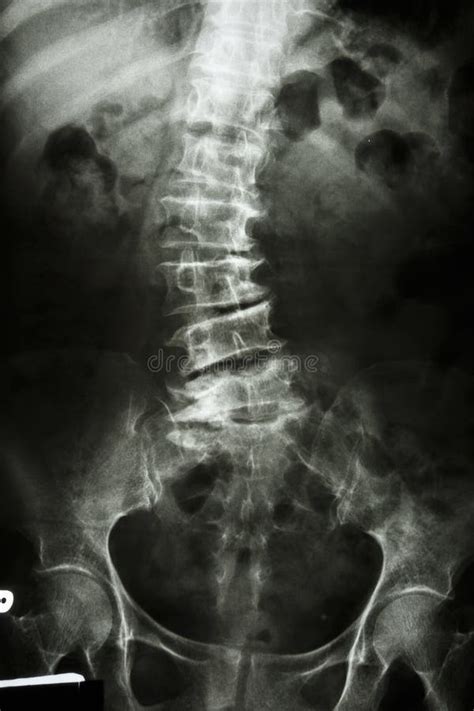 Mri Of Lumbar Spine Mr Stock Image Image Of Lumbar 13978373