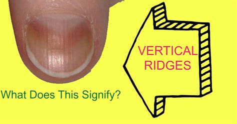 Do you have vertical ridges on your fingernails? This could signify… | Depke Wellness