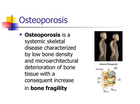 Osteoporosis prevention and management | PPT | Free Download