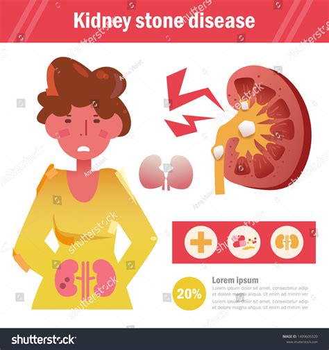 Kidney Stone Disease Vector Cartoon Isolated Stock Vector Royalty Free