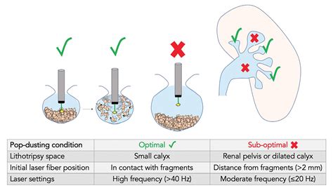 Journal Briefs The Journal Of Urology Laser Lithotripsy Role Of