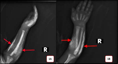 Iatrogenic Calcinosis Cutis In A Preterm Infant Pediatrics Neonatology