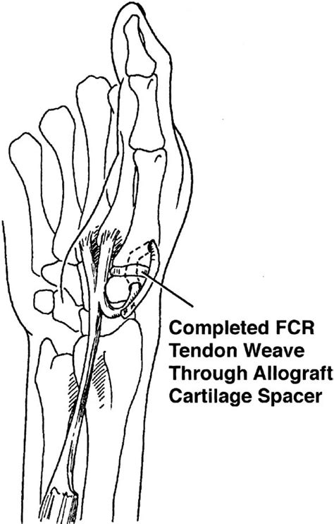 Thumb Trapeziometacarpal Joint Arthritis Partial Trapeziectomy With