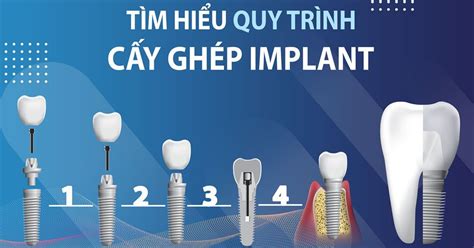 QUY TRÌNH CẮM IMPLANT CHUẨN Y KHOA Nha Khoa Đại Nam