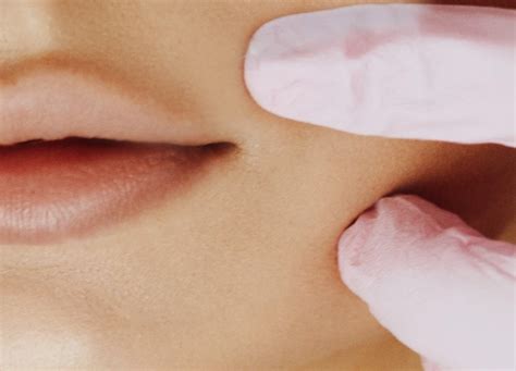 Dissolving Migrated Lip Filler What You Need To Know