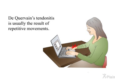 De Quervains Tendonitis