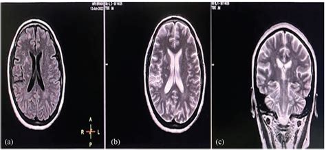 Follow Up Magnetic Resonance Imaging After 3 Months A FLAIR Axial