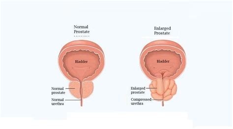 The Prostate Helal Medical