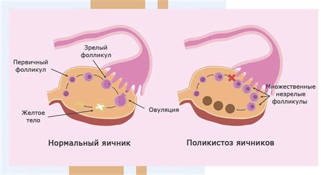 Дисфункция яичников: лечение, причины, симптомы и последствия