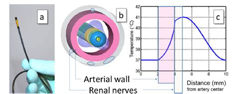 Ultrasound Catheter In Renal Artery A Catheter Prototype Used In