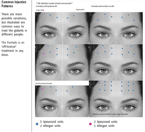 Top 3 BOTOX Injection Patterns Markup SkinViva Training