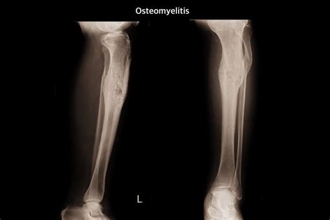 ¿qué Es La Osteomielitis