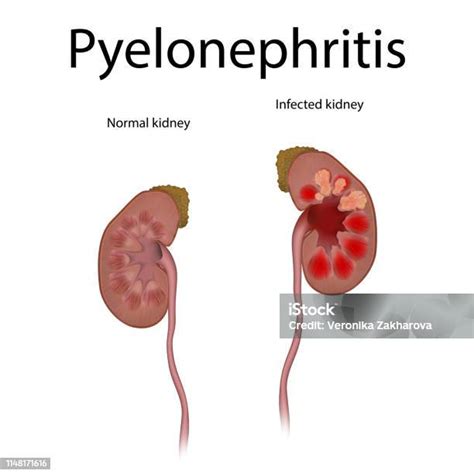 Ilustración De Pielonefritis Infección Renal Infectados Normales Sanos