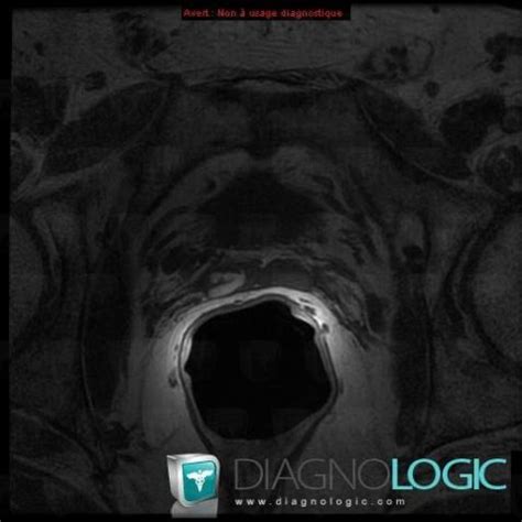 Radiology Case Hematoma Mri Diagnologic