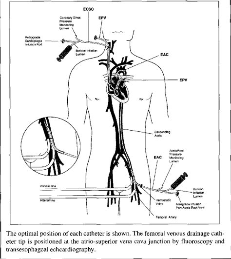 Endovascular Catheter System Download Scientific Diagram