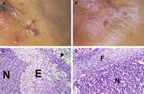 A Case 2 A Cluster Of Brown Red Papules Prior To Minocycline Download Scientific Diagram