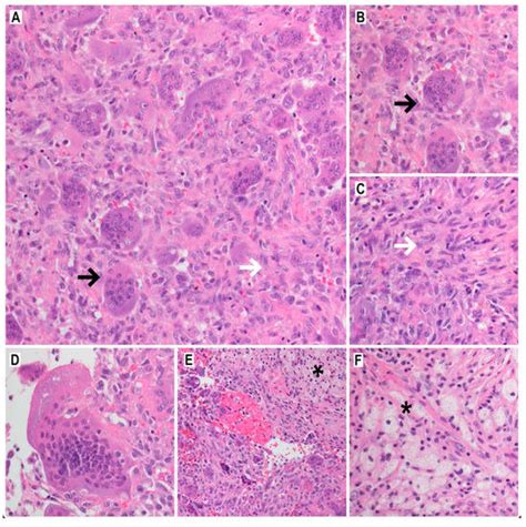 Cancers Free Full Text Denosumab In Giant Cell Tumor Of Bone