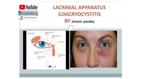 Lacrimal Apparatus And Dacryocystitis Youtube