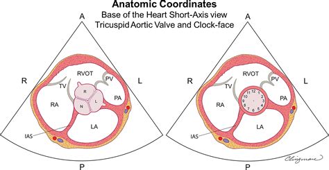 International Consensus Statement On Nomenclature And Classification Of The Congenital Bicuspid